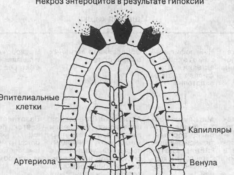 Скоропостижная смерть у взрослых при заболеваниях пищеварительной системы.  Встречается редко.  Относят –